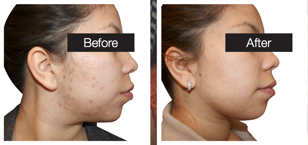 Acne Treatments Before and After Picture