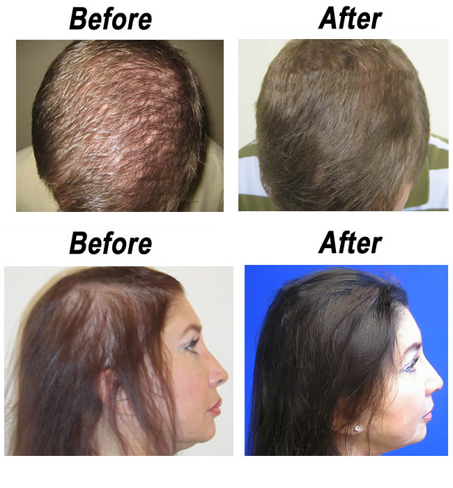 Regrow Your Hair Before It All Falls Out Buffalo Laser Spa