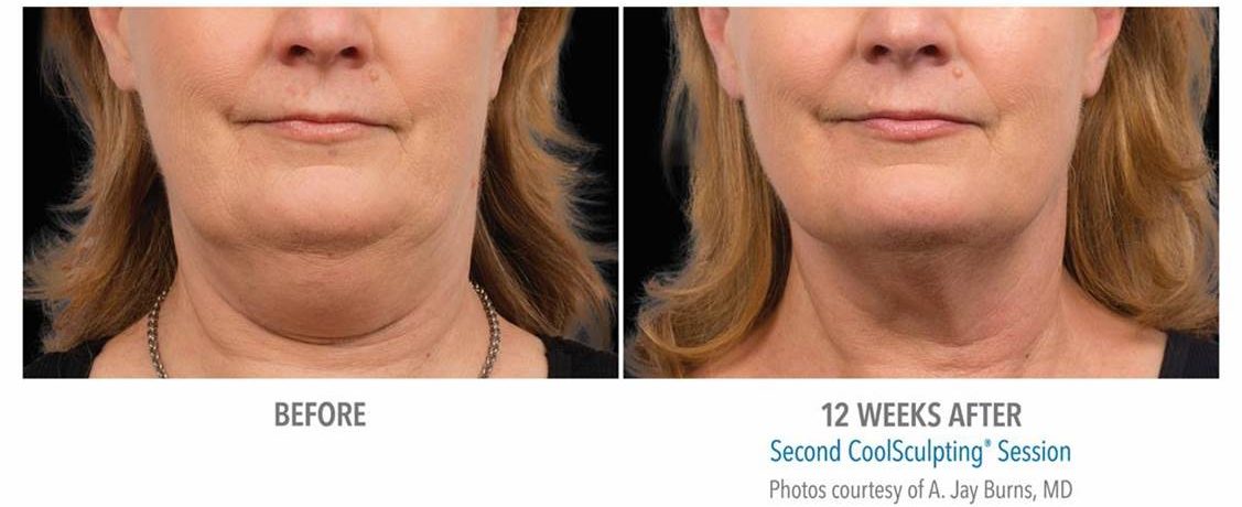 Double Chin Fat Before & After Results